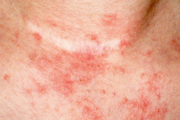 Mögliches Hautbild bei einer leichten Psoriasis