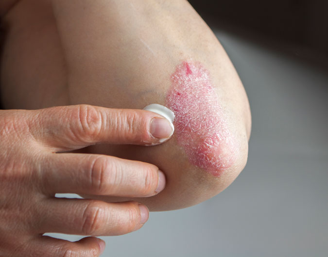 psoriasis verstehen aeusserliche therapieoptionen