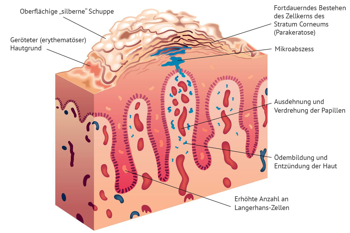 psoriasis-verstehen-definition-haut psoriasis verstehen definition haut