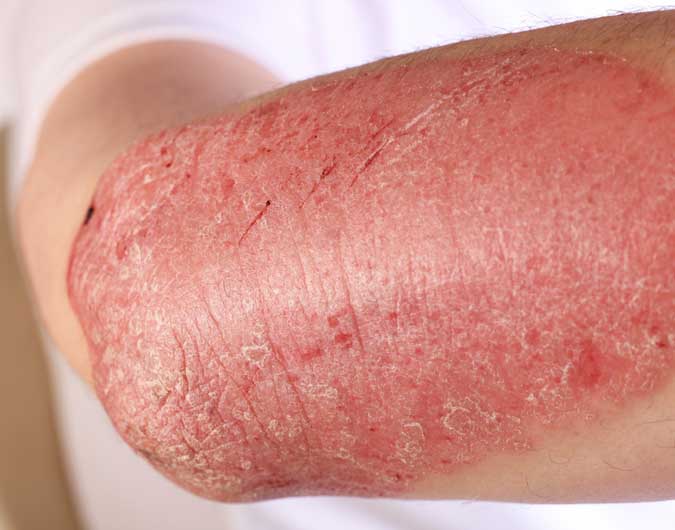 psoriasis-verstehen-erscheinungsformen-arm