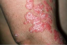 Psoriasis am Arm