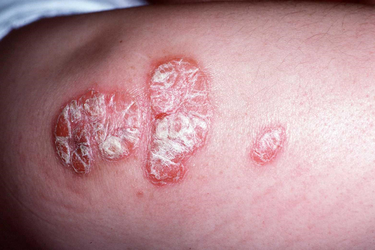 Psoriasis am Ellenbogen