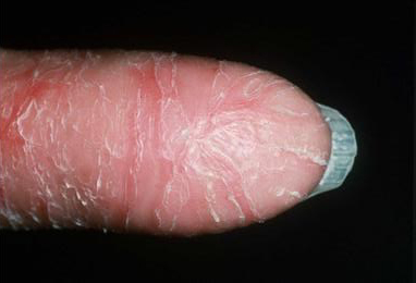 Psoriasis am Finger