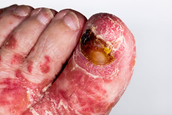 Psoriasis am Fußrücken und den Fußnägeln 