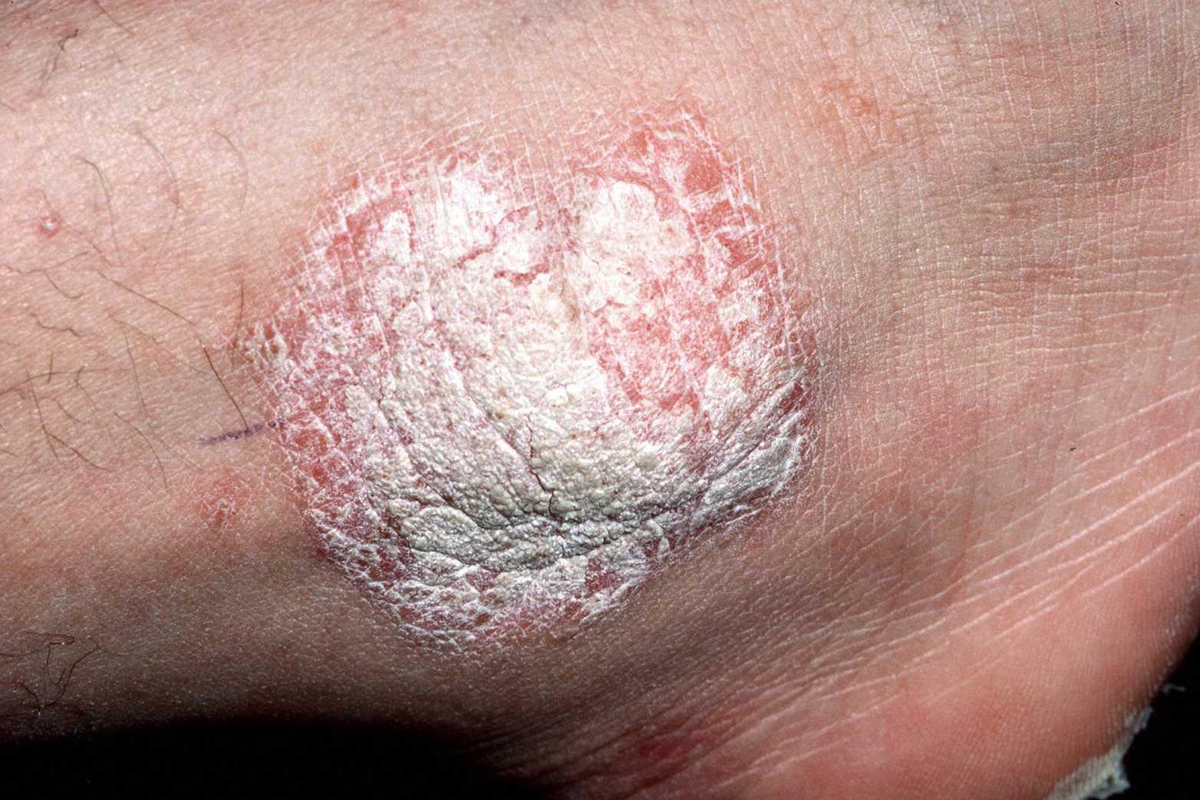 Psoriasis am Fußknöchel