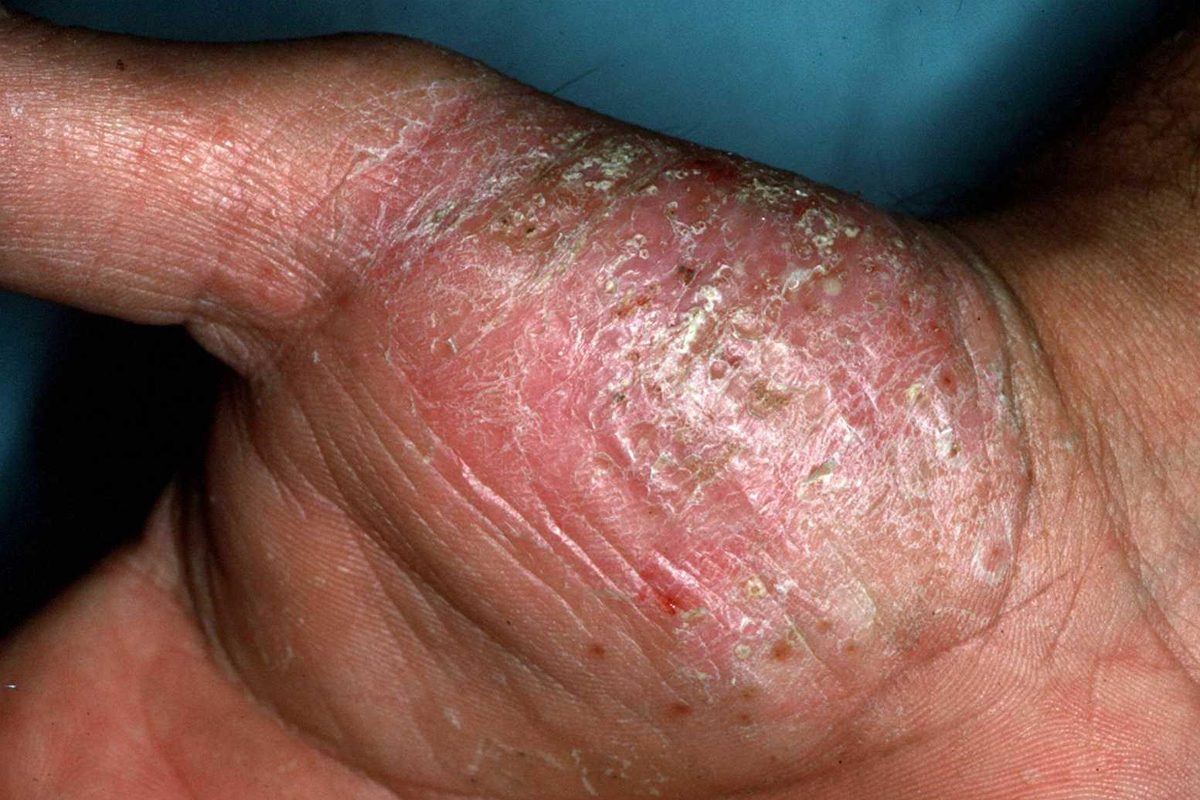 psoriasis-verstehen-erscheinungsformen-handballen