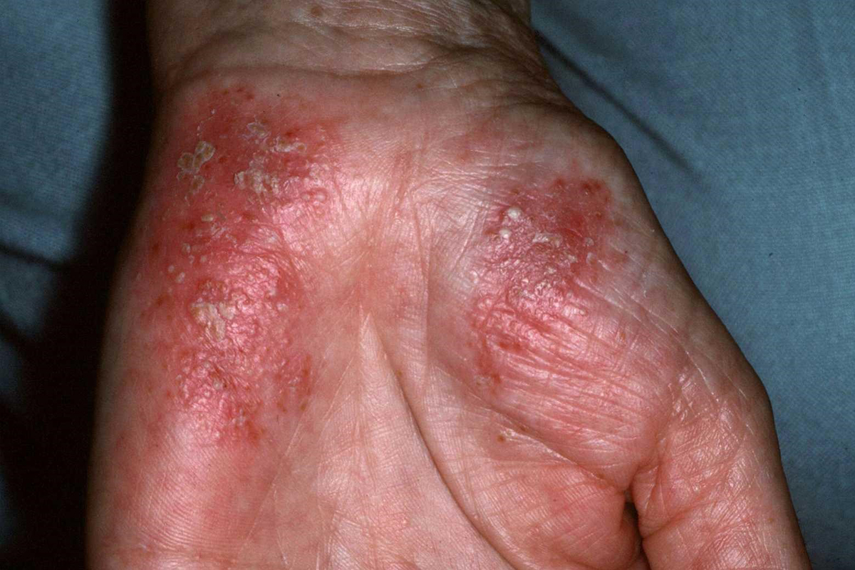 Psoriasis in der Handfläche
