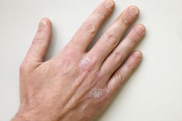 Leichte Psoriasis am Handrücken und den Fingernägeln