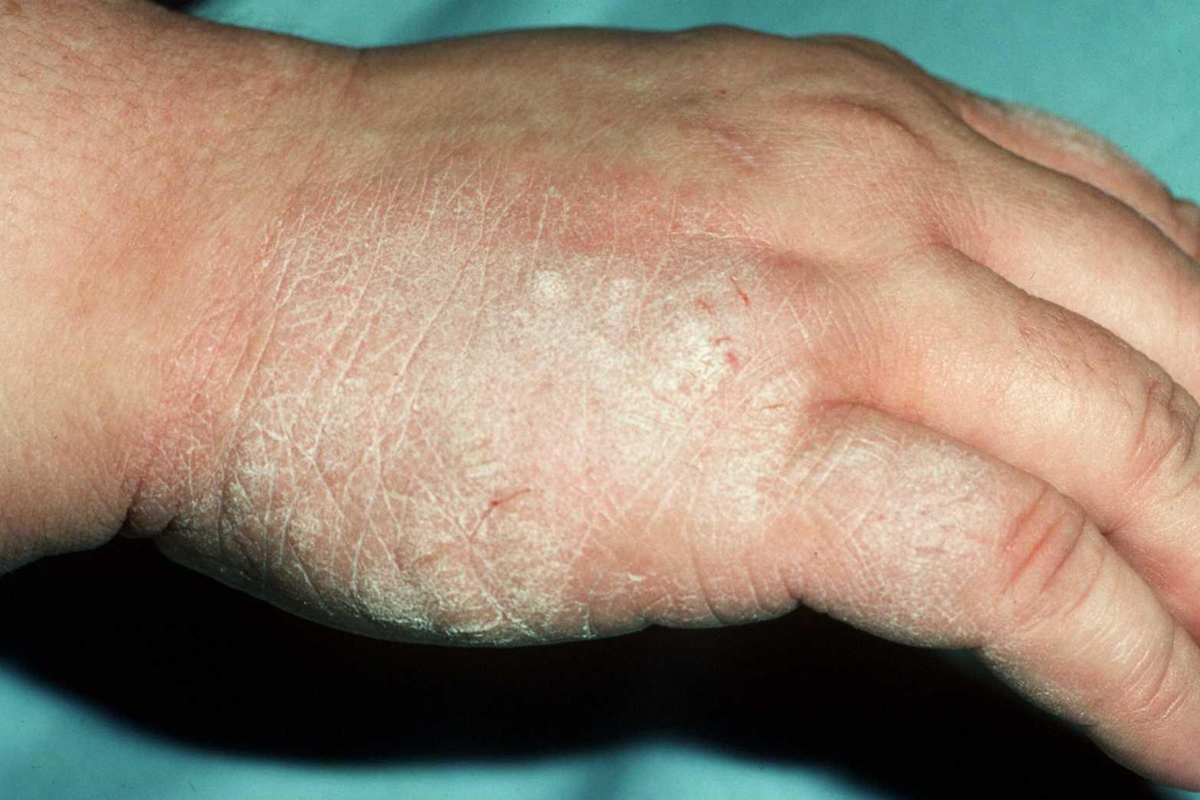 Psoriasis auf dem Handrücken