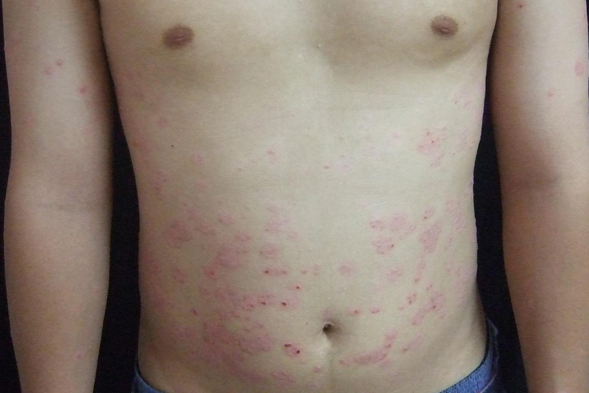 Psoriasis am Oberkörper