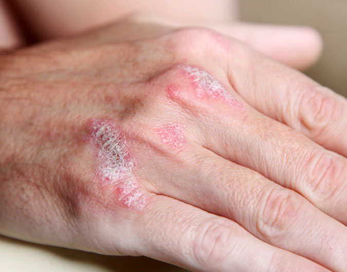 psoriasis verstehen erscheinungsformen