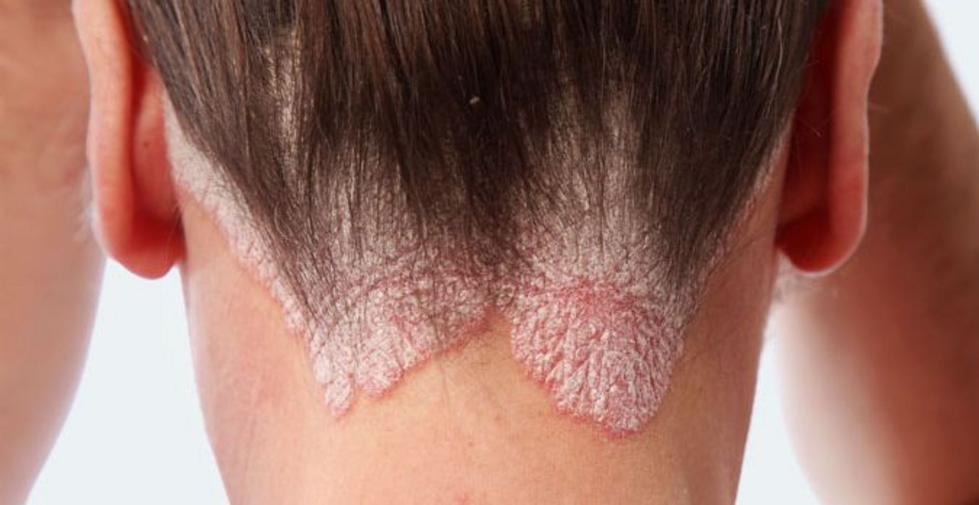 psoriasis verstehen ursachen frau mit psoriasis