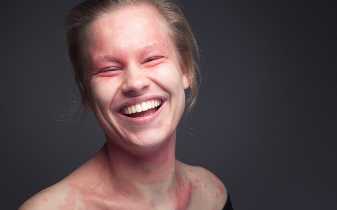 Laura erzählt ihre Neurodermitis Geschichte