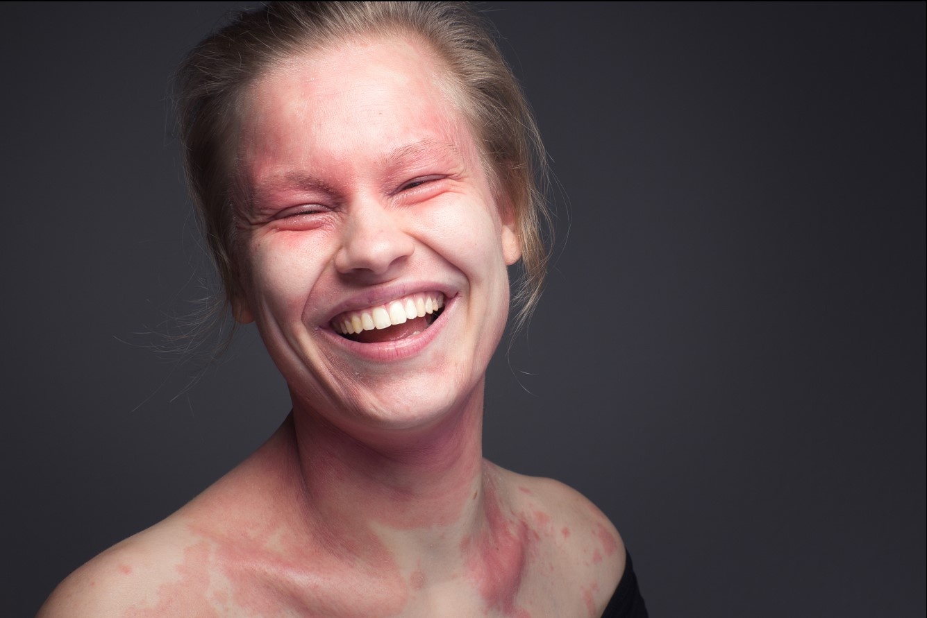 neurodermitis betroffene berichten laura lachend