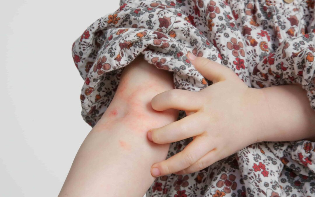 Neurodermitis bei Kindern: Ursachen, Symptome und Tipps für Eltern