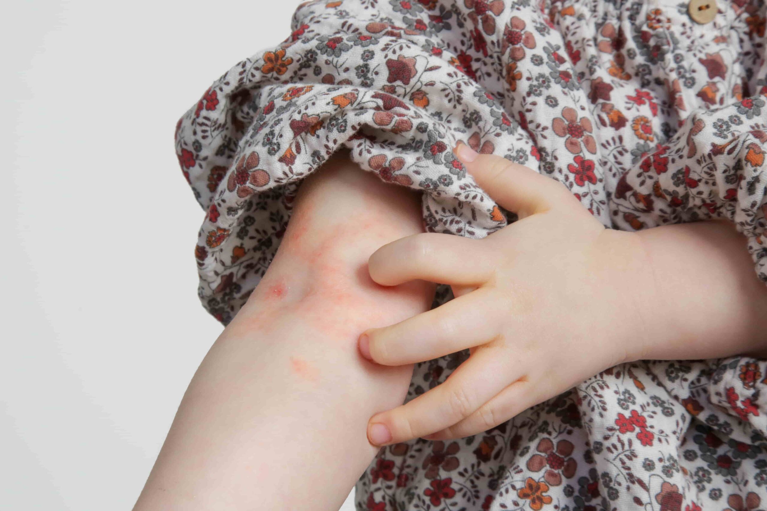 neurodermitis ratgeber kinder