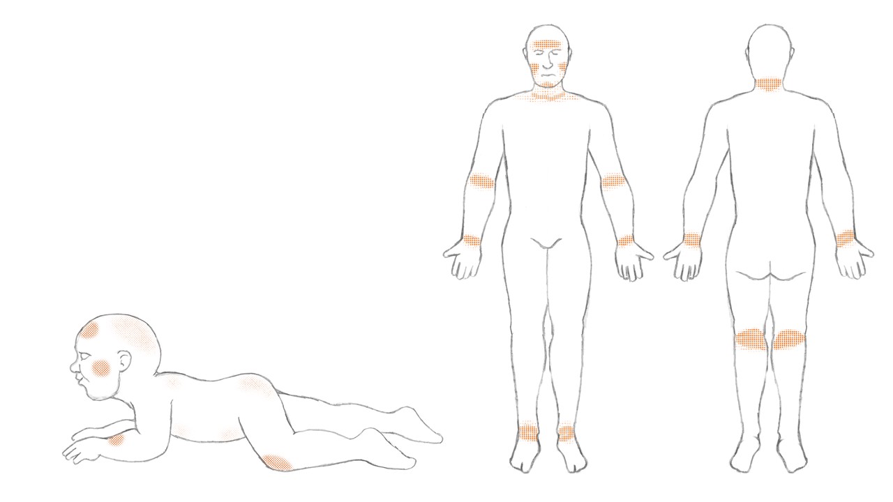 neurodermitis verstehen definition skizze