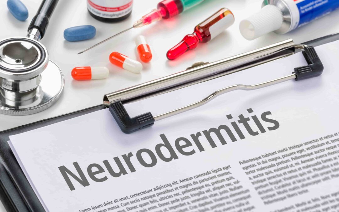 Neurodermitis behandeln: Innerliche Therapien bei der chronischen Hauterkrankung