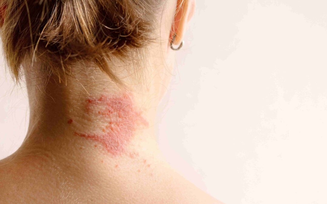 Neurodermitis verstehen: Ursachen und individuelle Auslöser der Chronischen Hauterkrankung