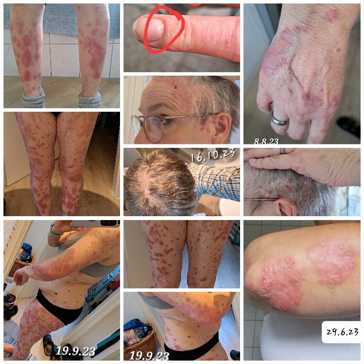 Psoriasis Betroffenen Kollage
