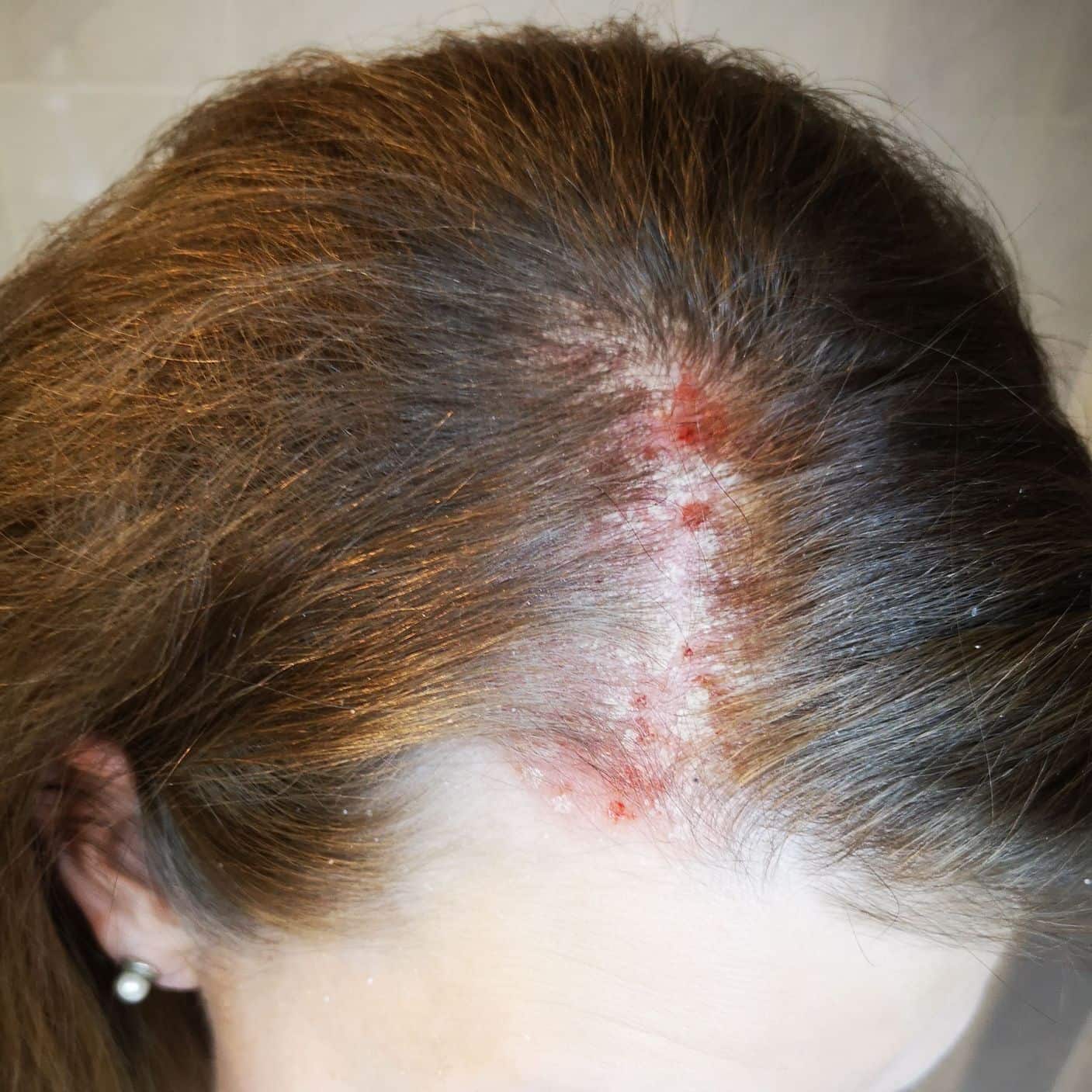 Psoriasis Betroffenengeschichte Isabell Kopfhaut