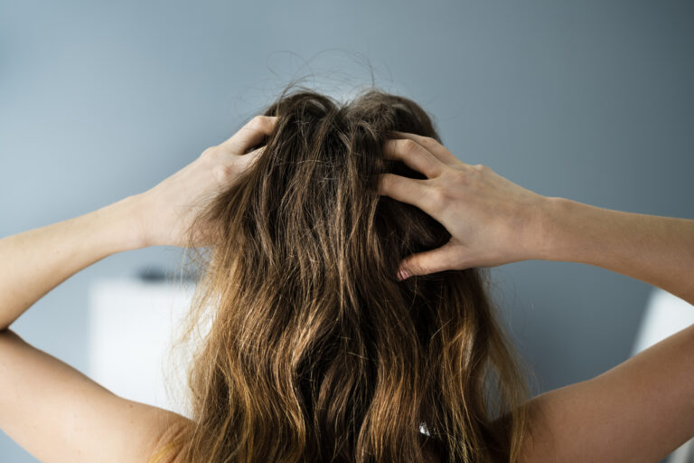 Juckende trockene Kopfhaut und langes Haar mit Schuppen