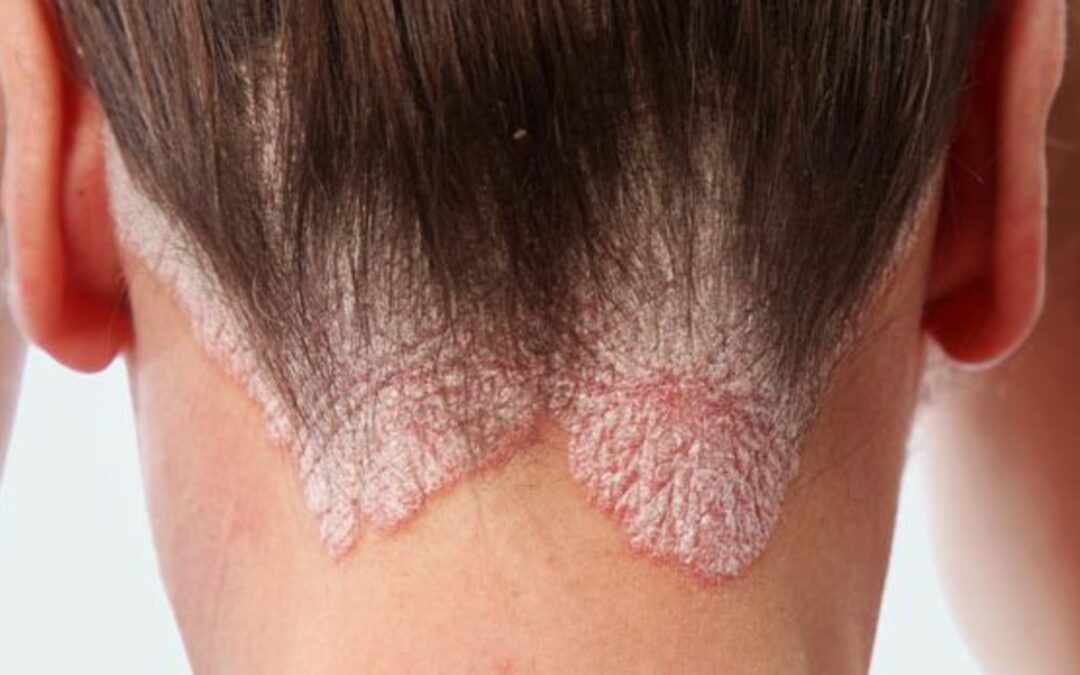 Ursachen von Psoriasis
