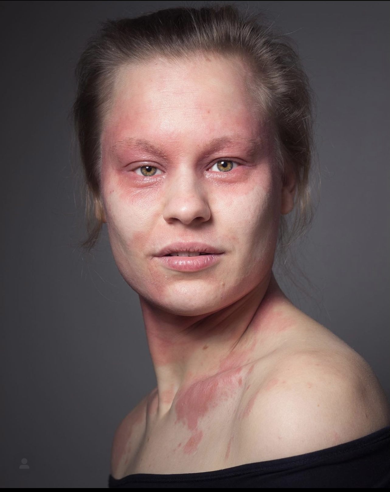 neurodermitis betroffene berichten laura