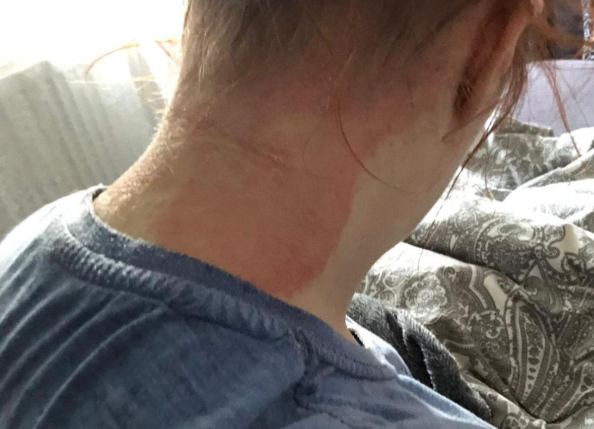 psoriasis betroffene berichten vanessa psoriasis kopf nacken