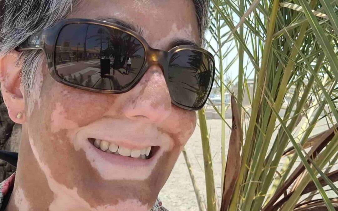 Bowie Miles erzählt ihre Vitiligo-Geschichte