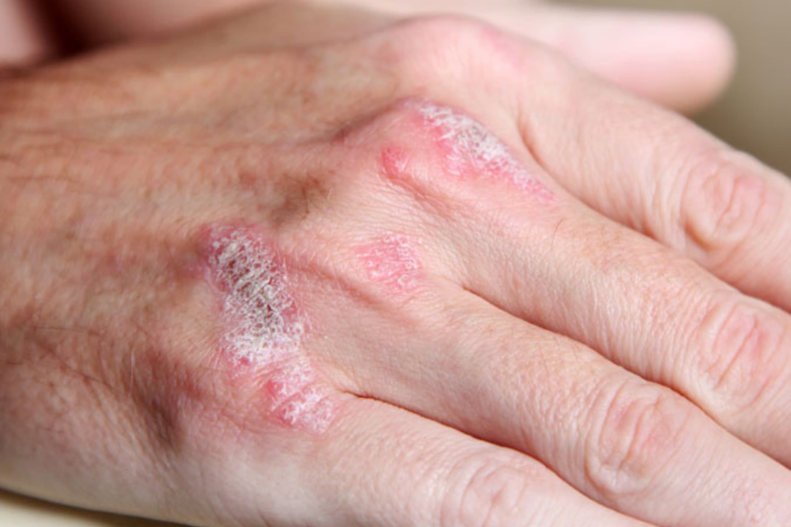 psoriasis-verstehen-erscheinungsformen