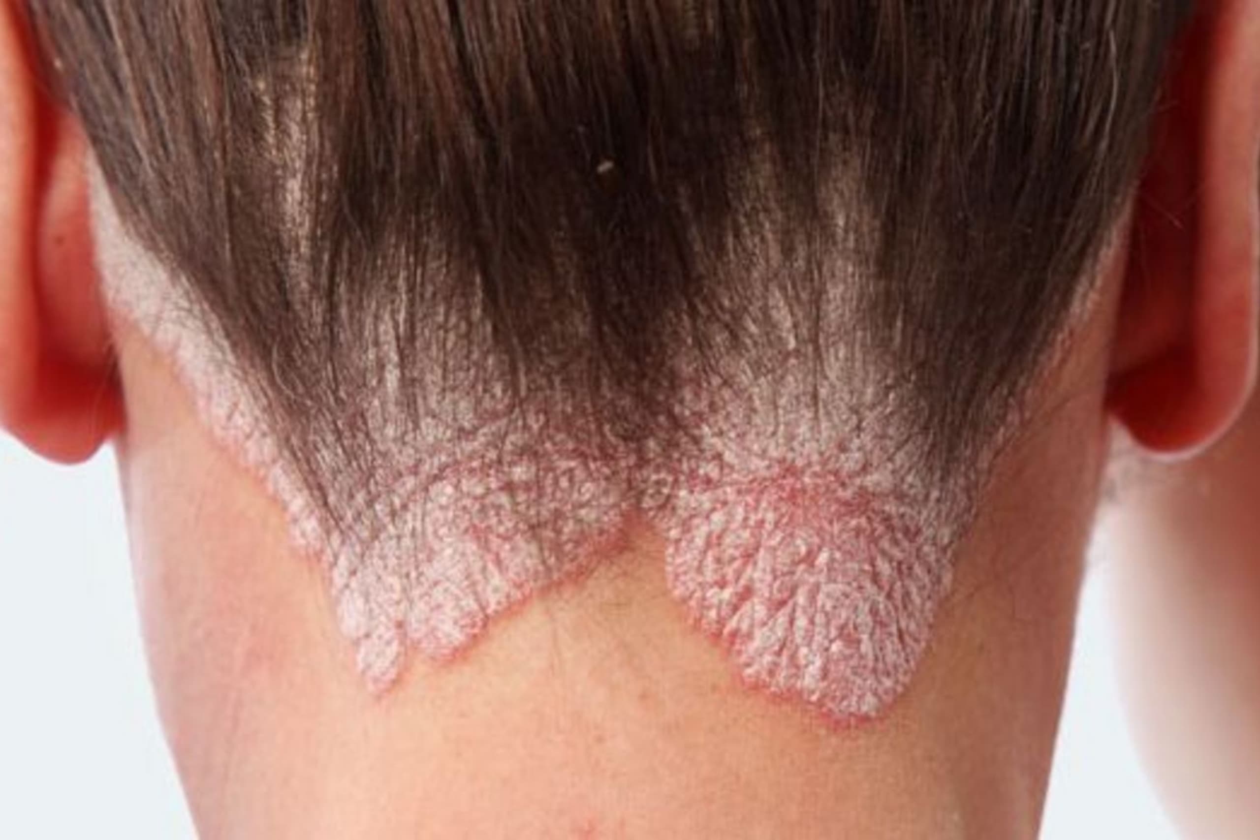 psoriasis-verstehen-ursachen