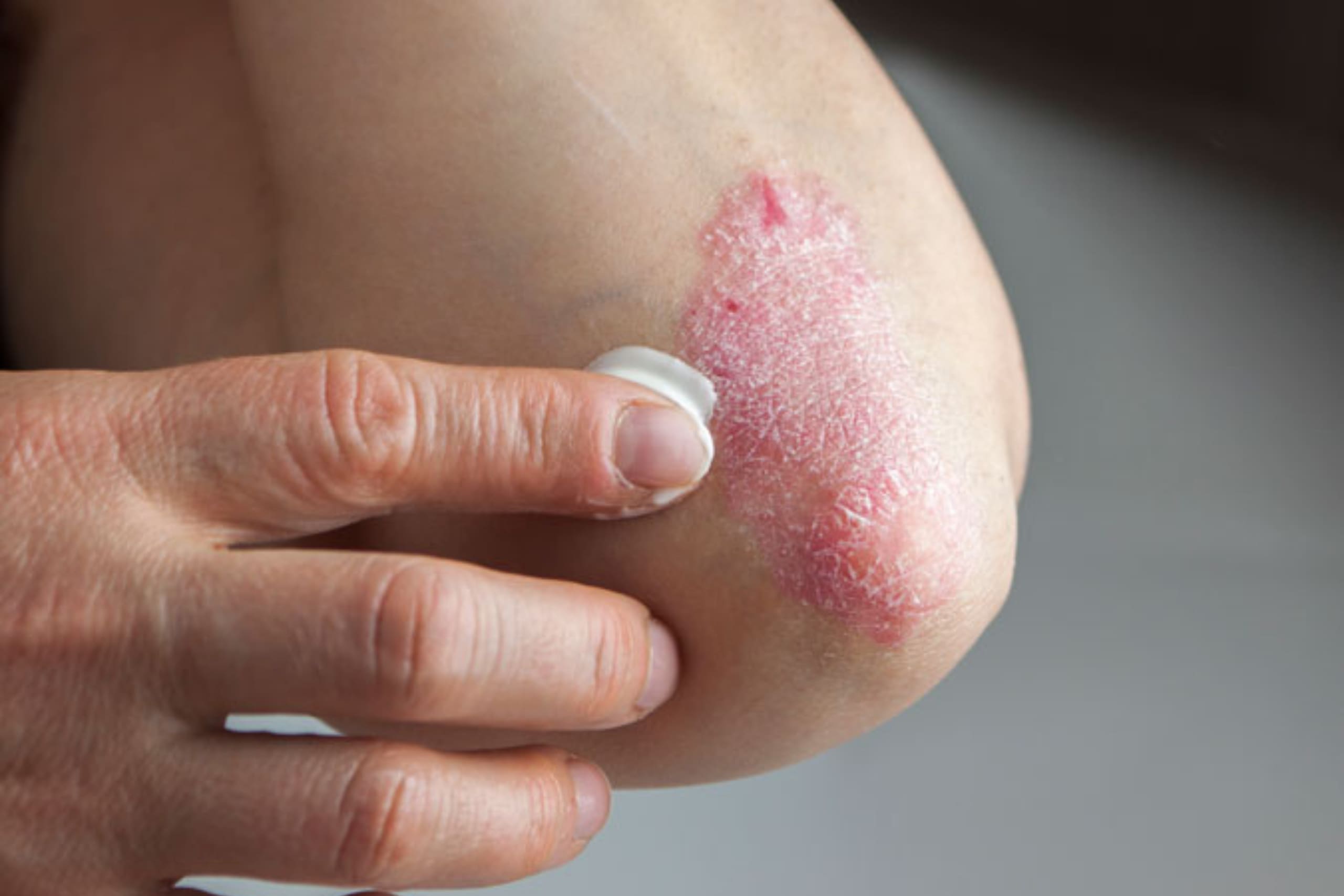 psoriasis-verstehen-aeusserliche-therapie-optionen
