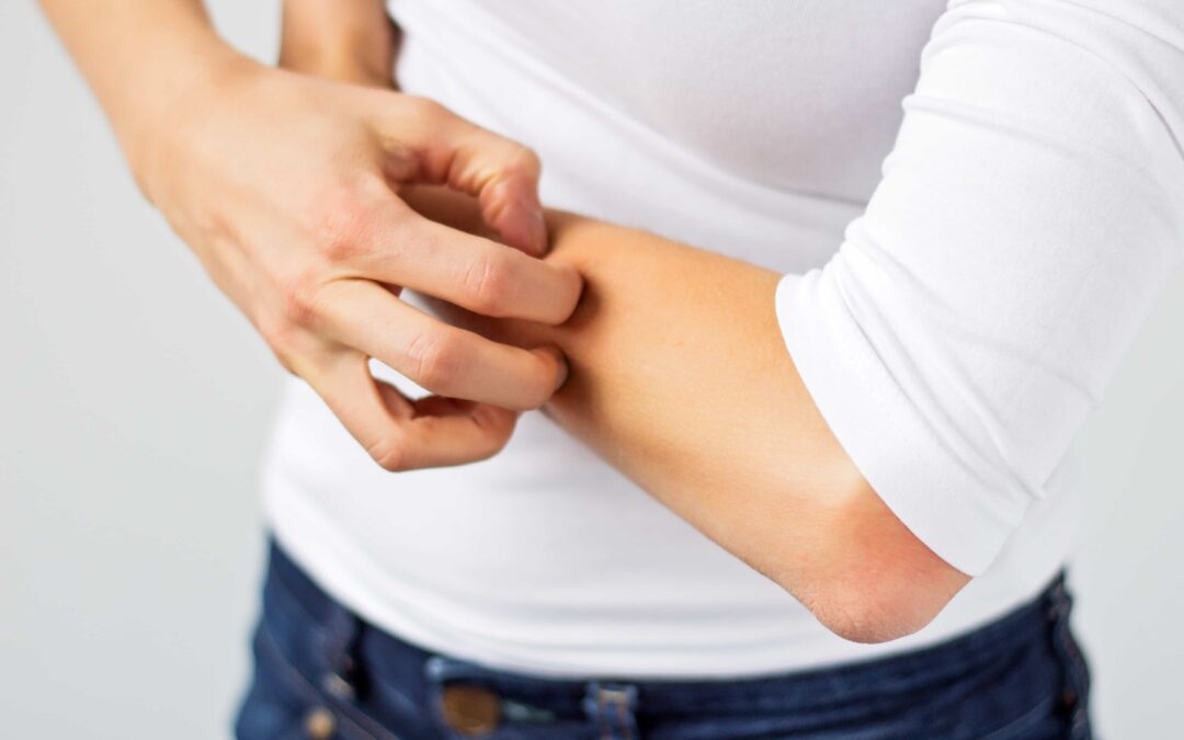 Was hilft bei Urtikaria? 6 Alltagstipps bei Juckreiz