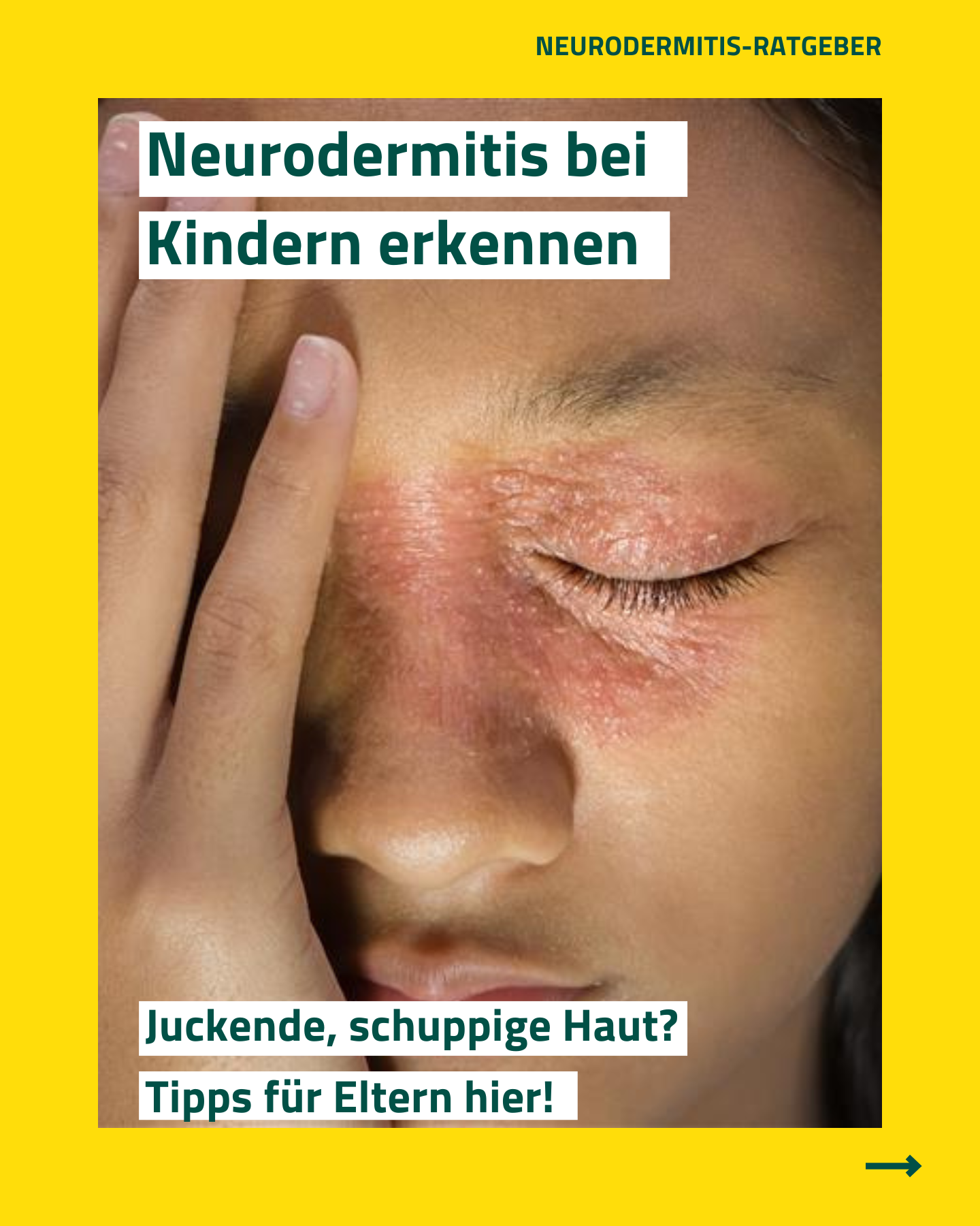 Neurodermitis erkennen bei Kindern