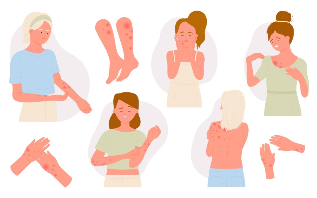 Definition und Symptome der Urtikaria