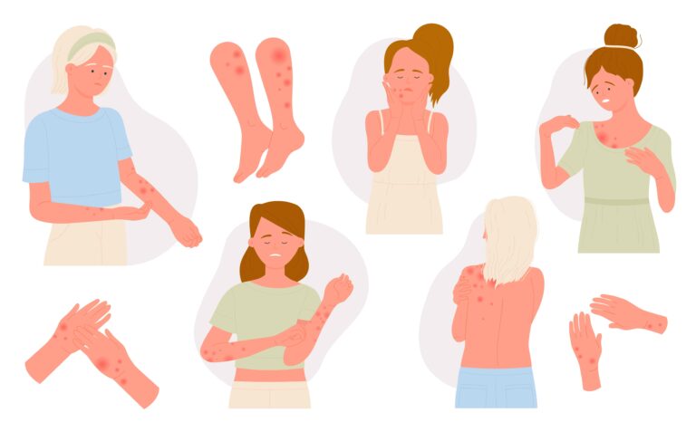 illustration urtikaria