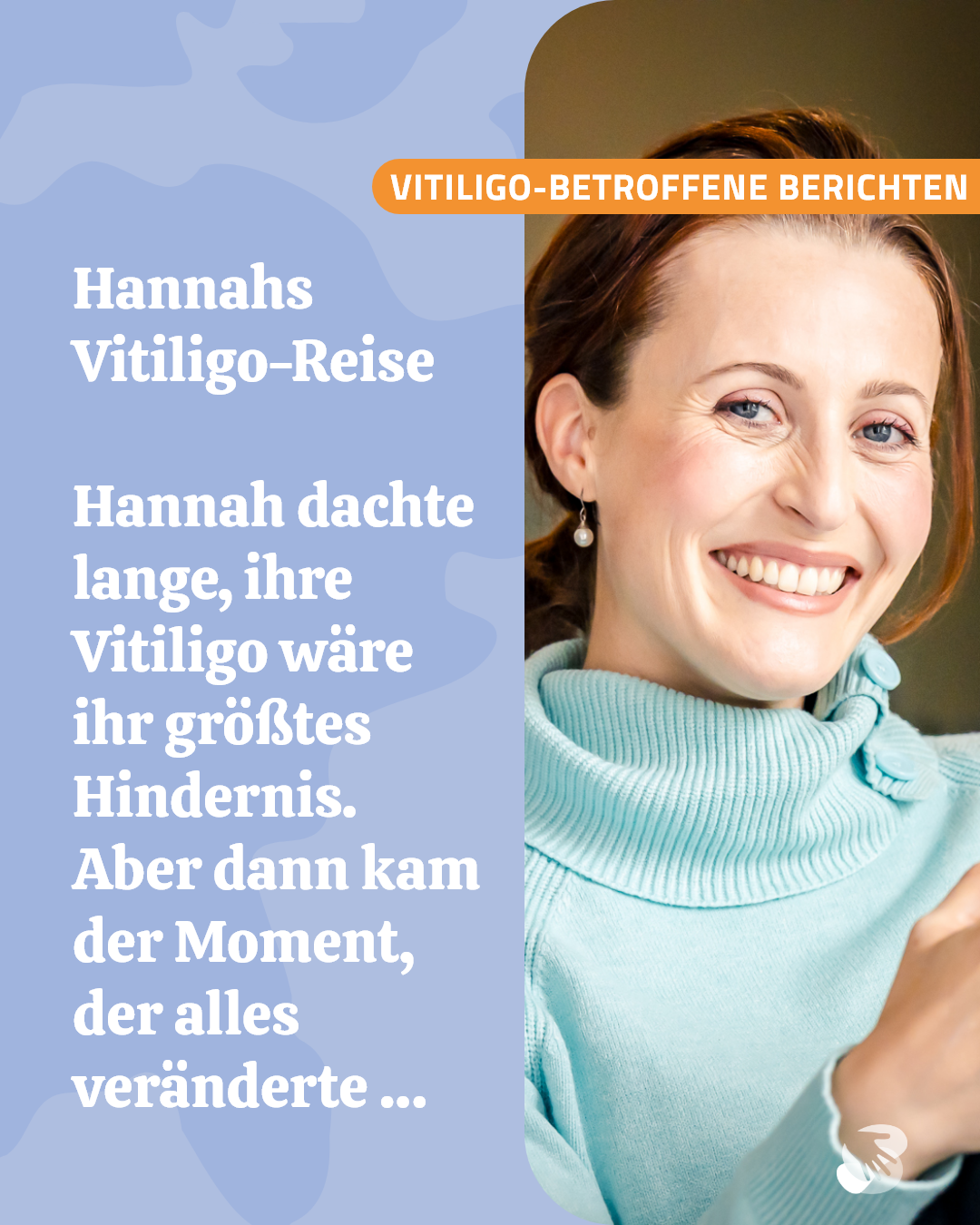 Hannahs Vitiligo Reise