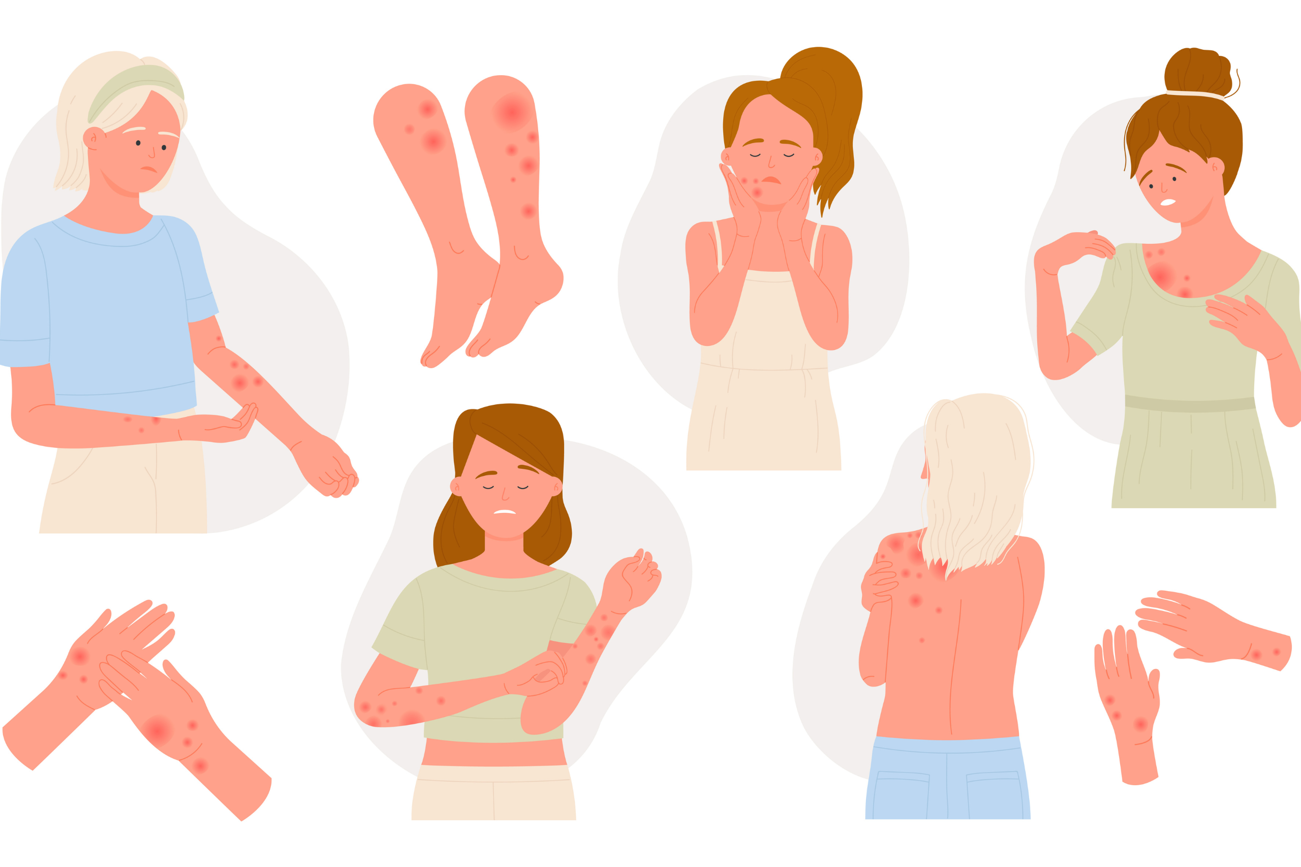 urtikaria-definition-symptome-teaser