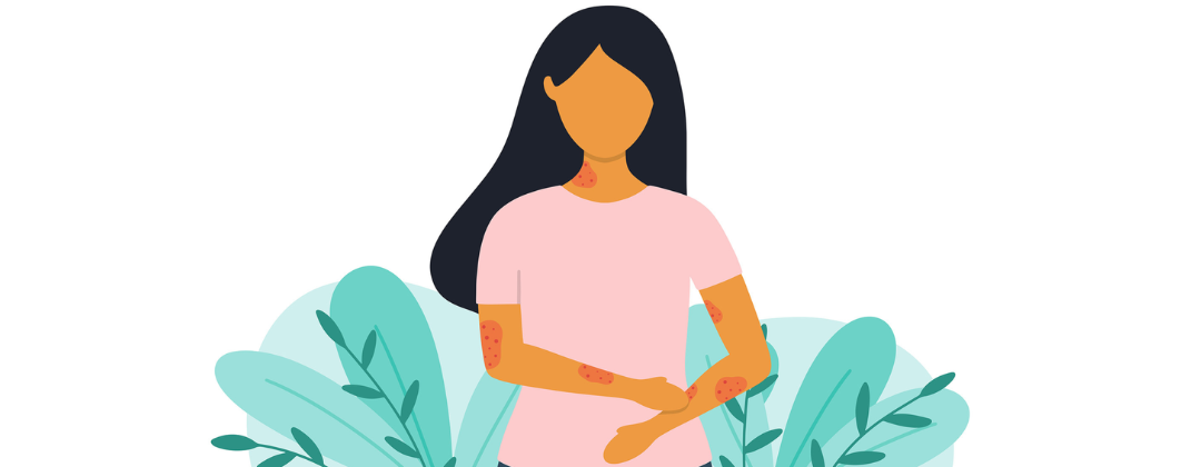 Formen und Auslöser von Urtikaria