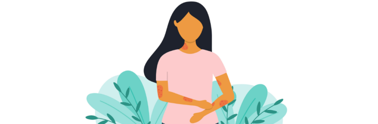 urtikaria-formen-und-auslöser-keyvisual