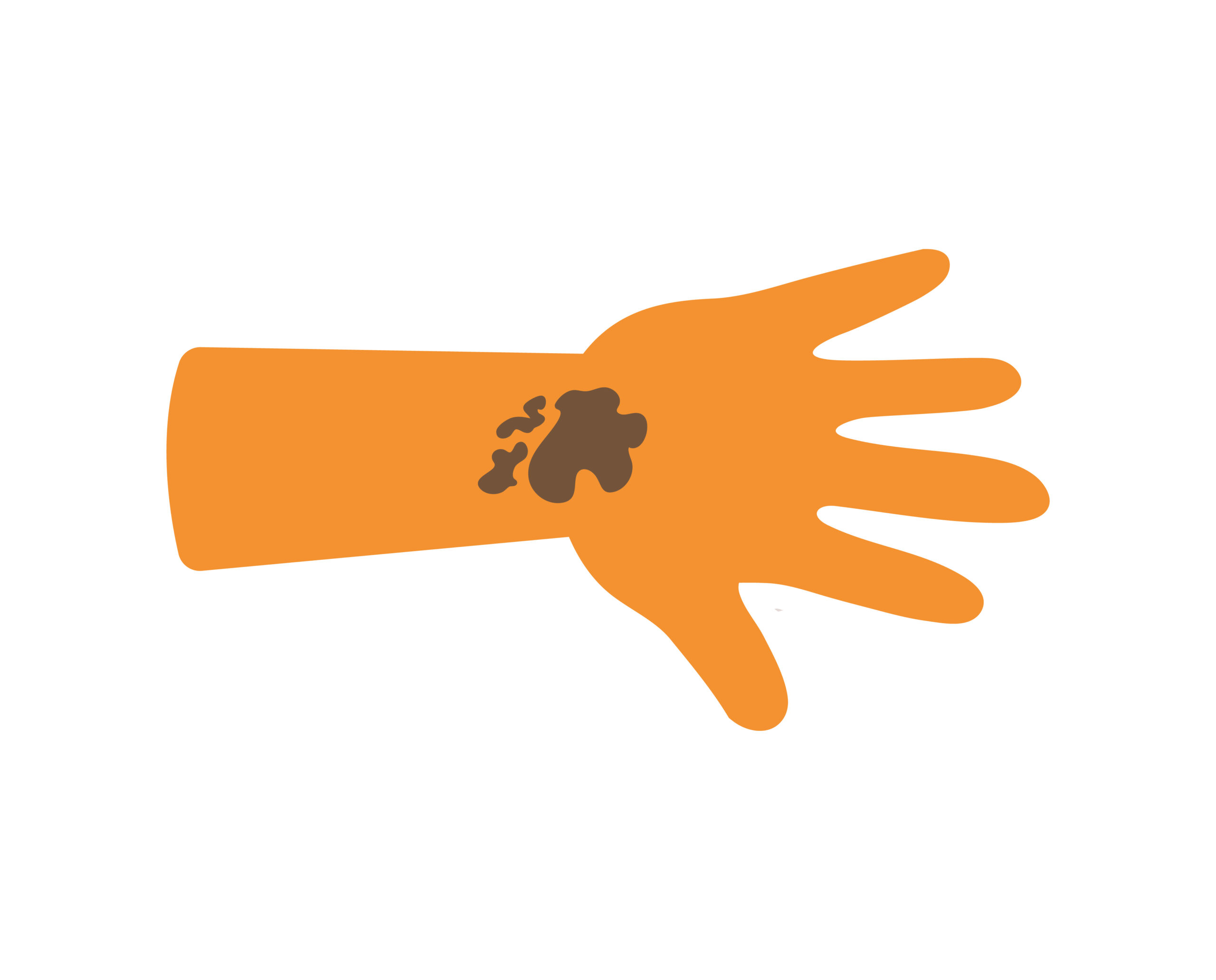 Hand mit Quaddeln & Rötungen