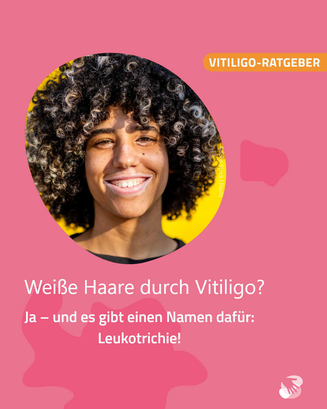 Weiße Haare durch Vitiligo?